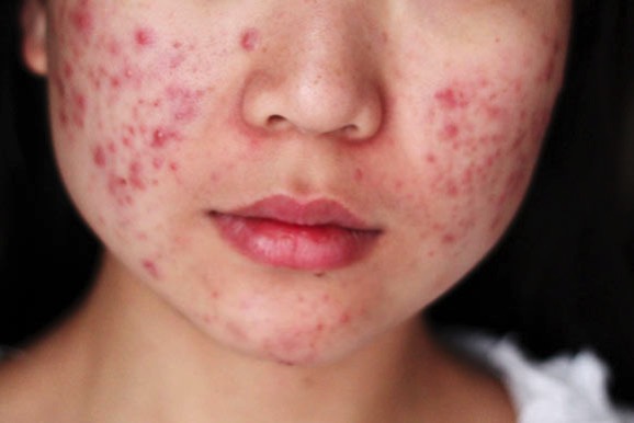 Acne1 579x386