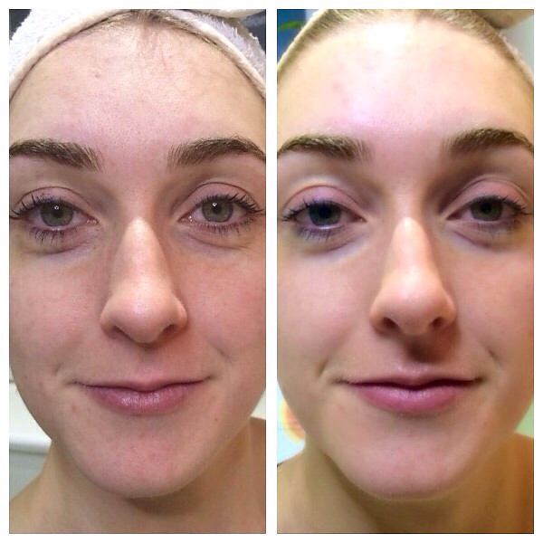 LED light therapy before and after jpg