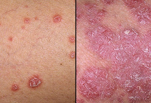 Dermnet rf photo of psoriasis symptoms jpg